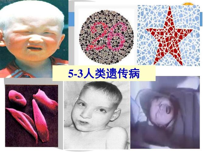  遗传病