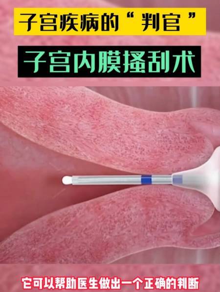 内膜搔刮