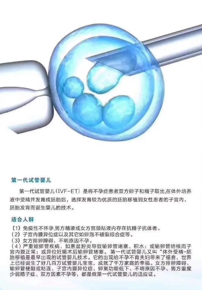 试管婴儿第一代
