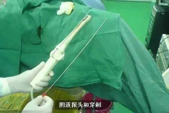 卵子取出