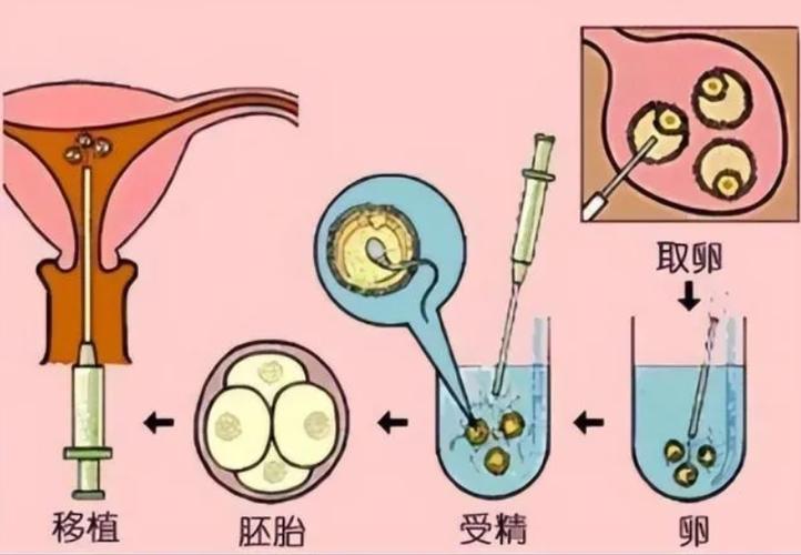 卵子捐赠