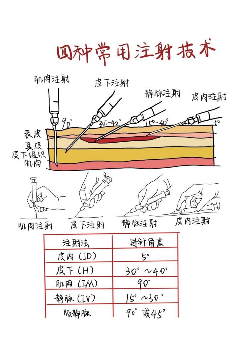  注射技术