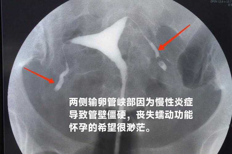 子宫输卵管造影