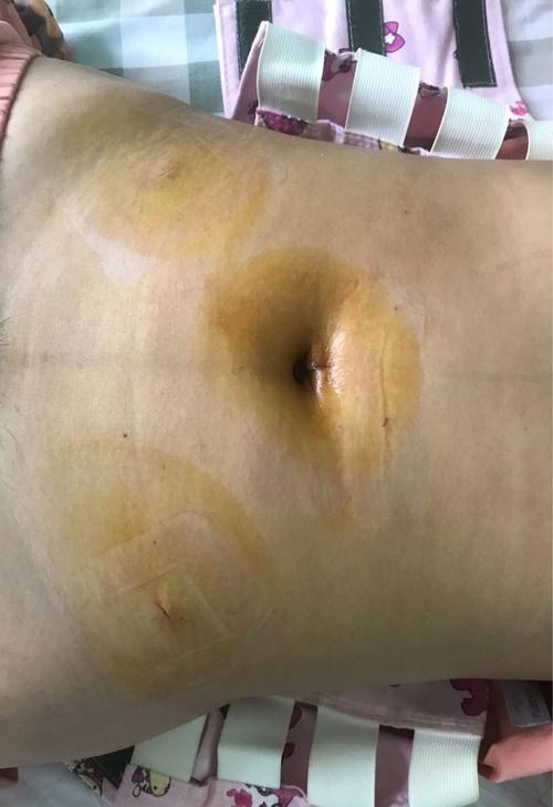 试管婴儿、生殖、医疗、孕育之痛、肚子疤痕