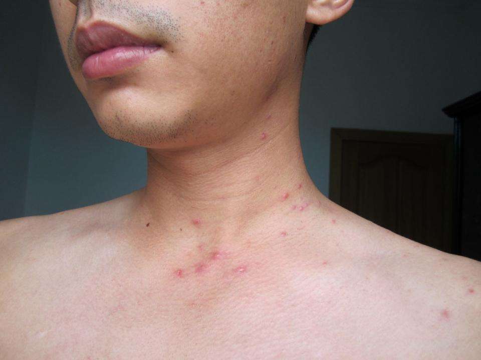 艾滋病患者