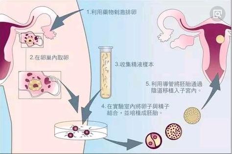 体外受精-胚胎移植技术(IVF-ET)