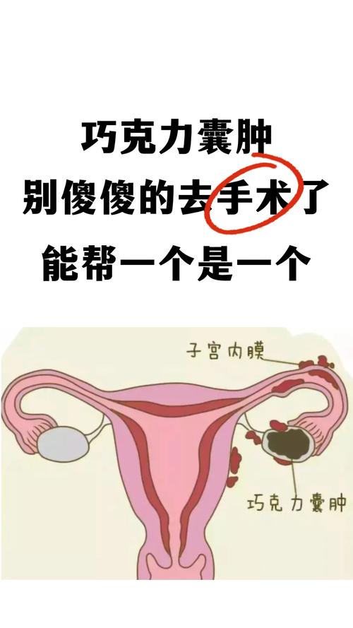 巧囊