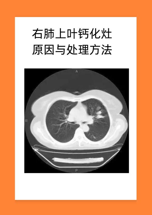 钙化问题