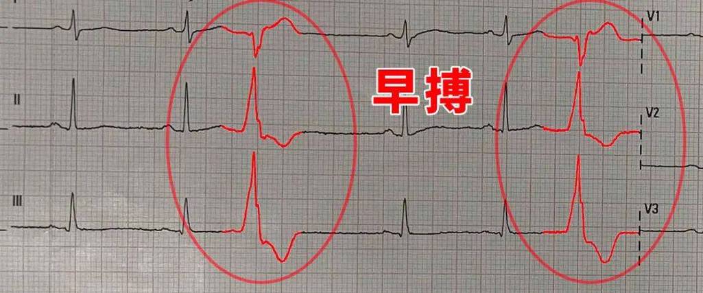 早搏