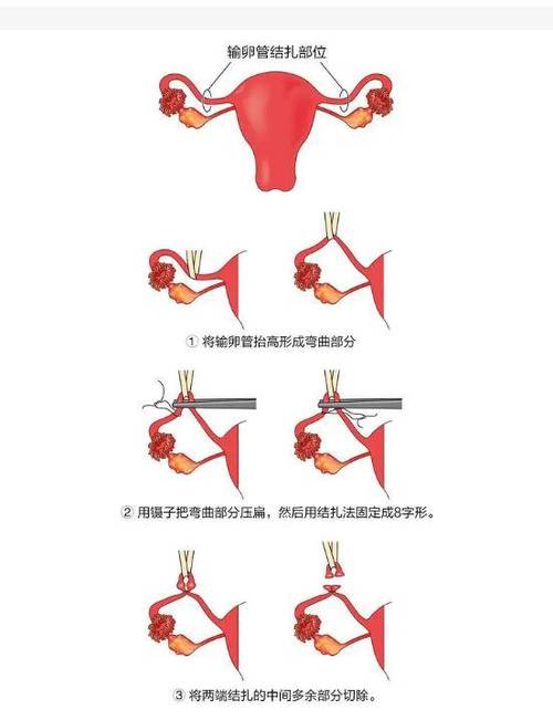 女方结扎