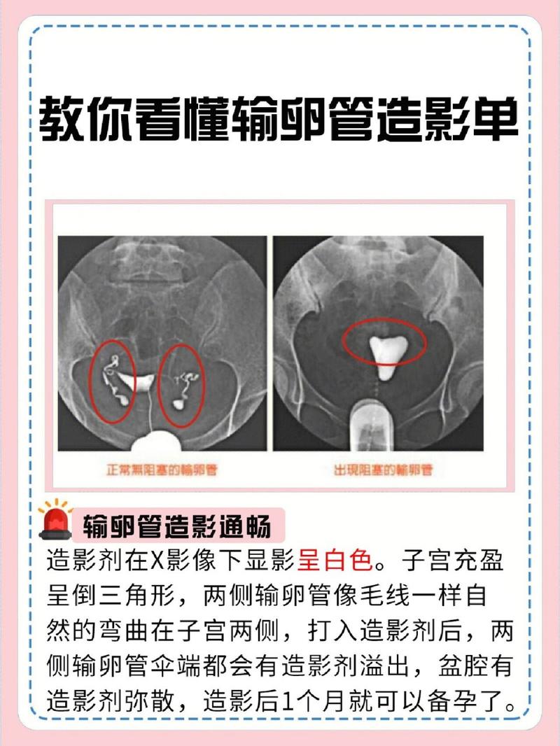 造影原因