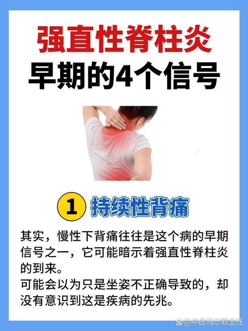 强直性脊柱炎