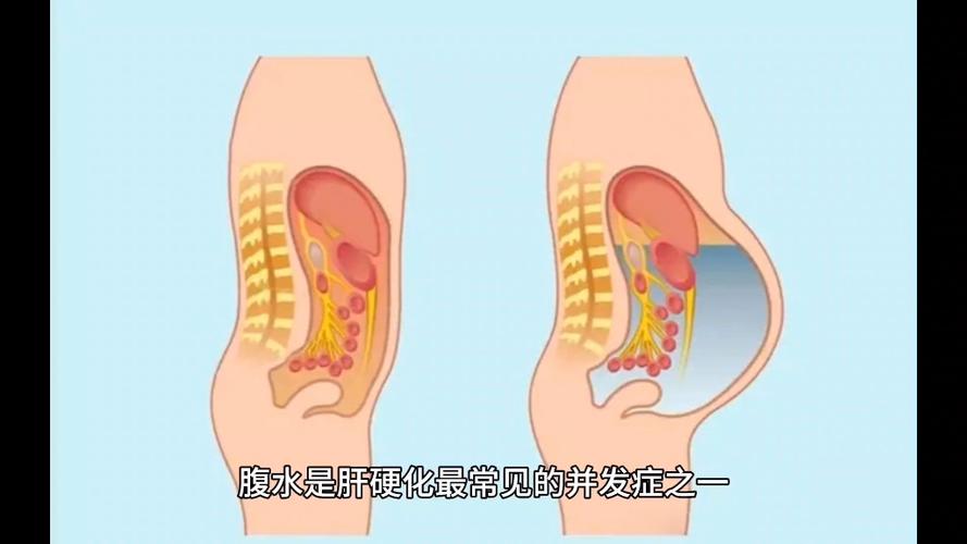生殖医疗
描述: 本文详细解析了试管婴儿并发症中腹水的表现，如腹部肿胀、腹痛等，并给出了不同程度腹水的应对方法，旨在帮助患者更好地了解和应对这一情况，助力试管婴儿治疗顺利进行 。