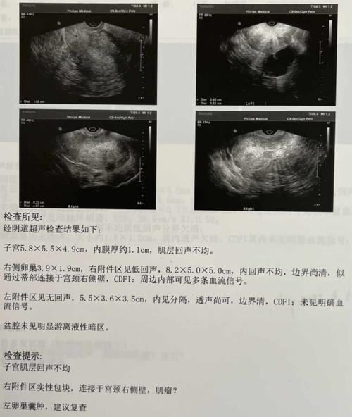 肌瘤复发