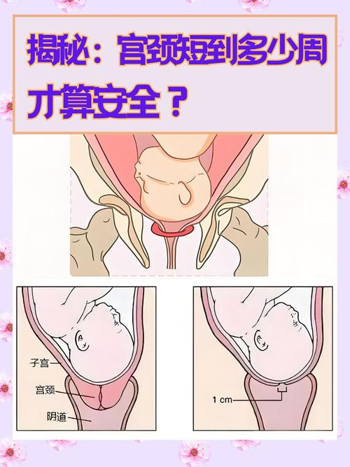  短宫颈