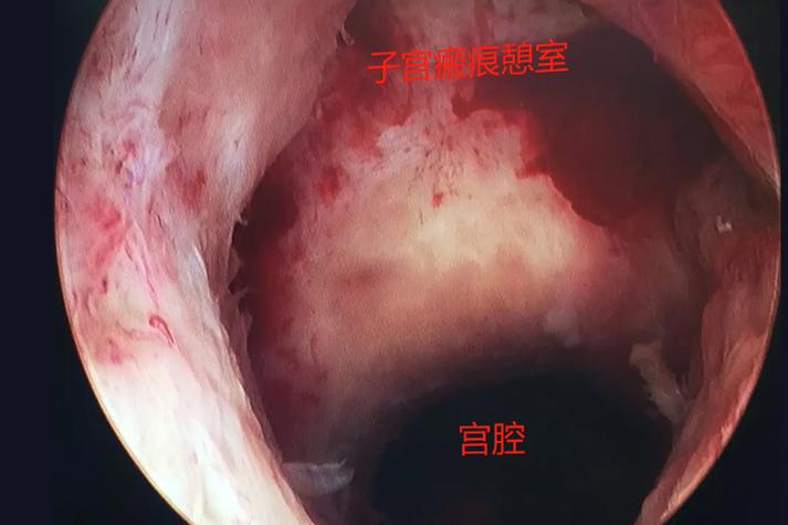 痕迹子宫
