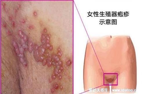 艾滋病女性