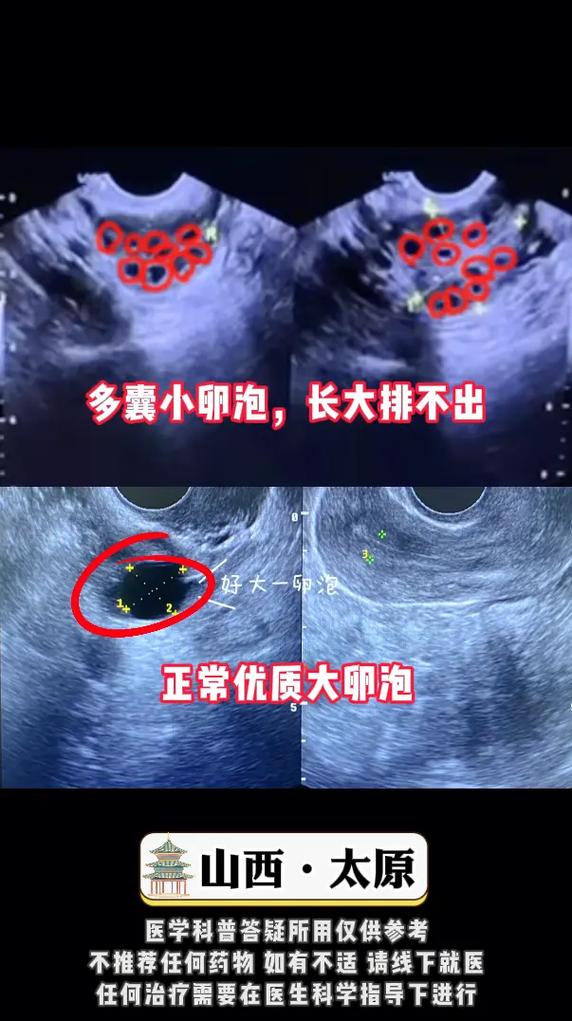 卵泡数量过多