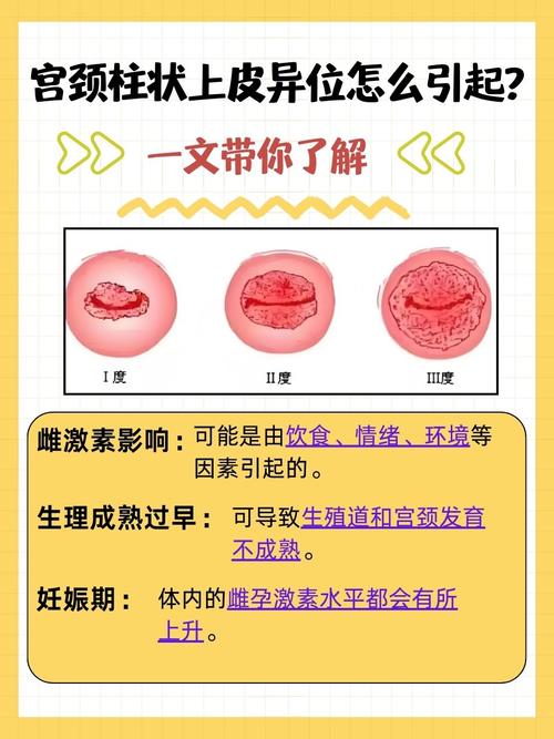 宫颈柱状上皮异位
