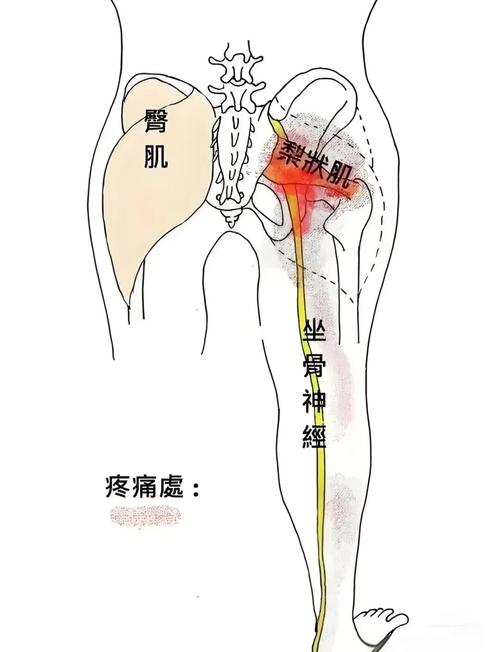 屁股痛