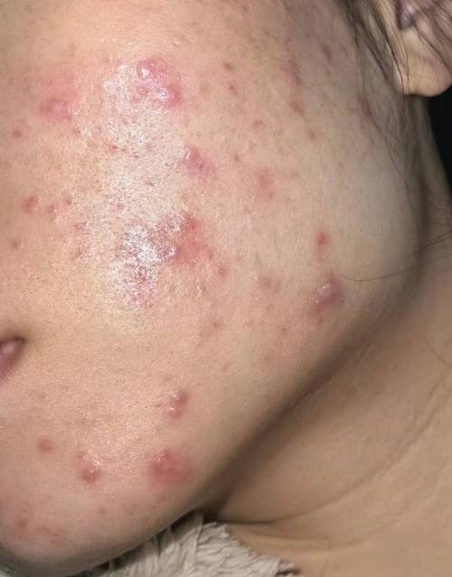  痘痘