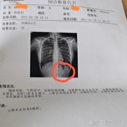 胸透检查
