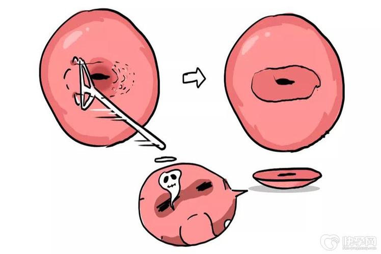 宫颈息肉患者能否安全进行试管婴儿治疗？