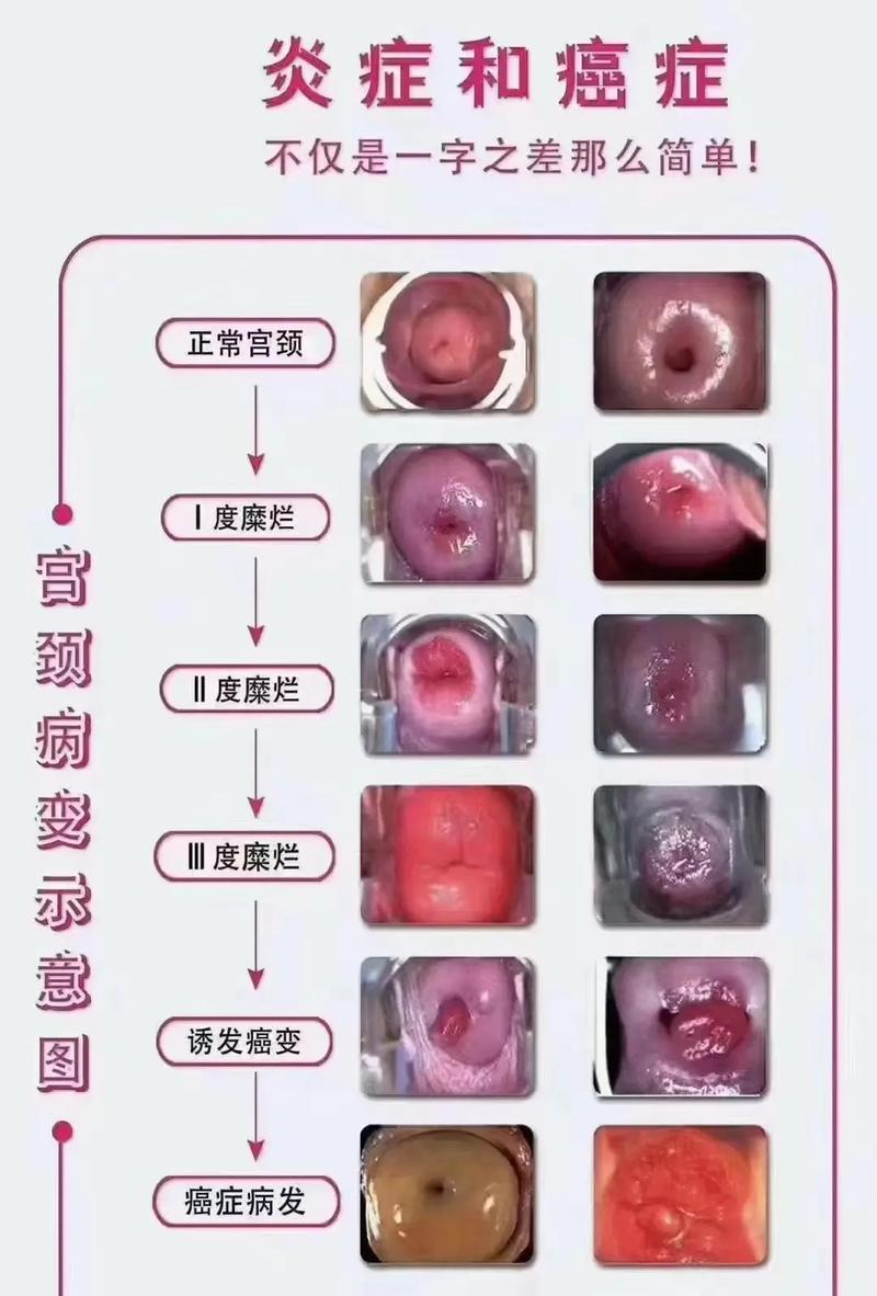 宫颈糜烂