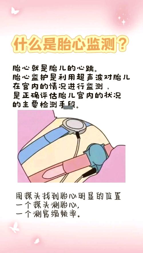 胎心监测