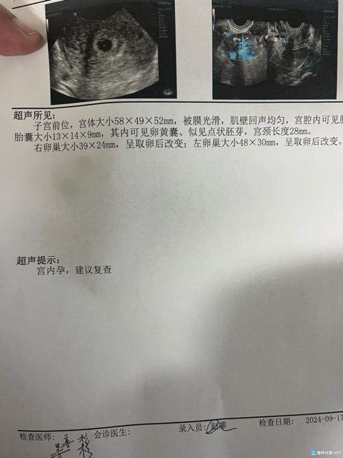 试管婴儿从移植到胎心确认需要几天？