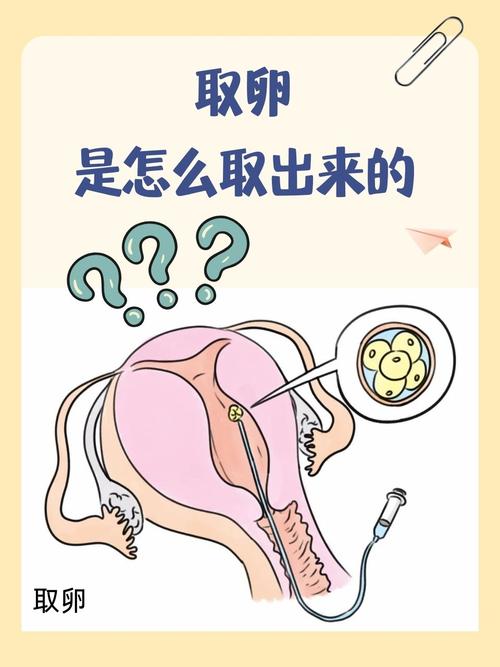 取卵后绝经