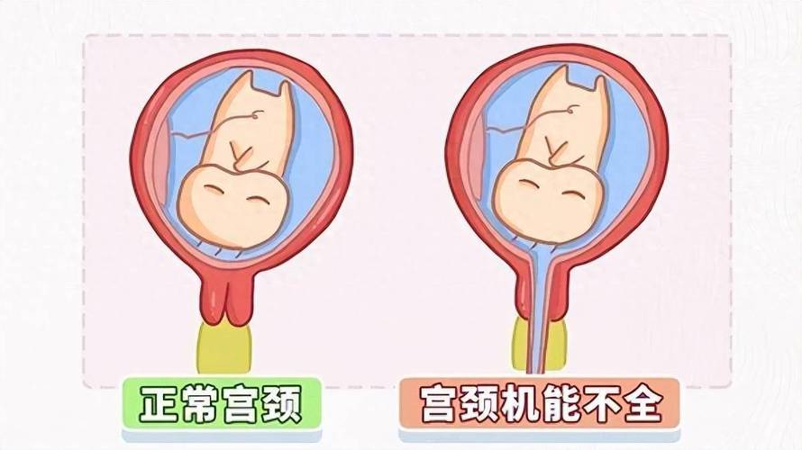 宫颈机能不全