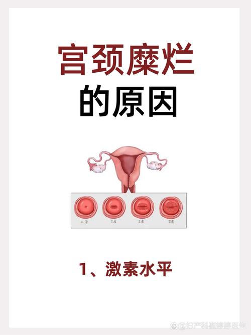宫颈因素