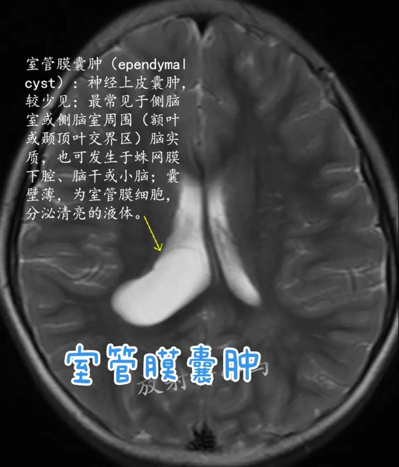 室管膜囊肿
