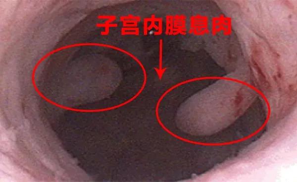  子宫内膜息肉