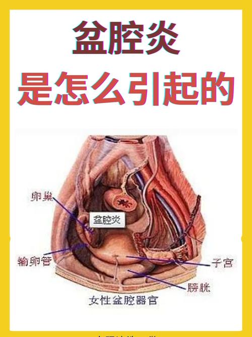 盆腔疾病