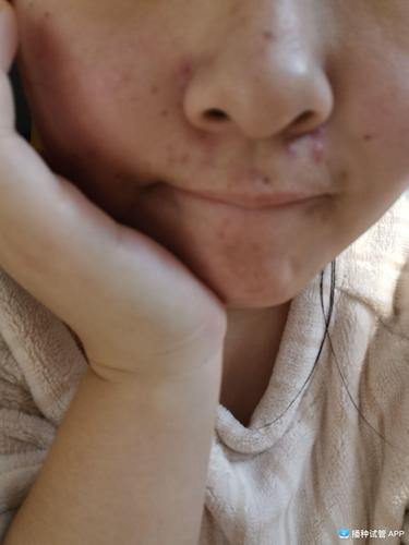 试管婴儿移植后出现的疙瘩有什么影响？