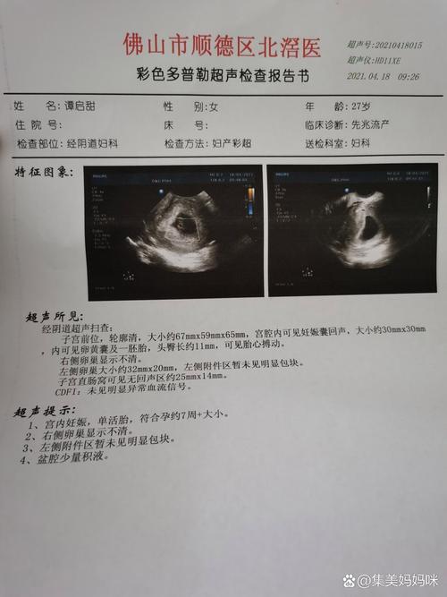 胎心搏动