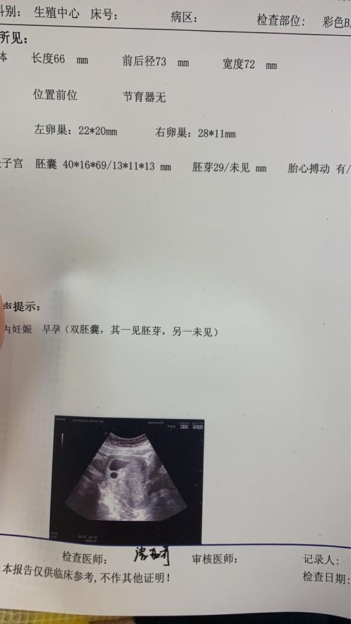 试管婴儿移植50天