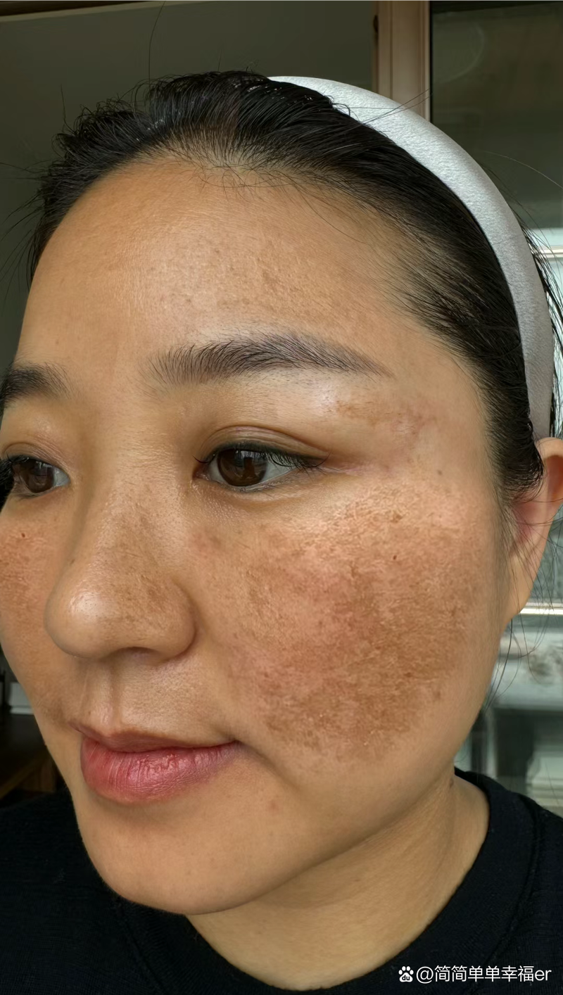脸上长斑