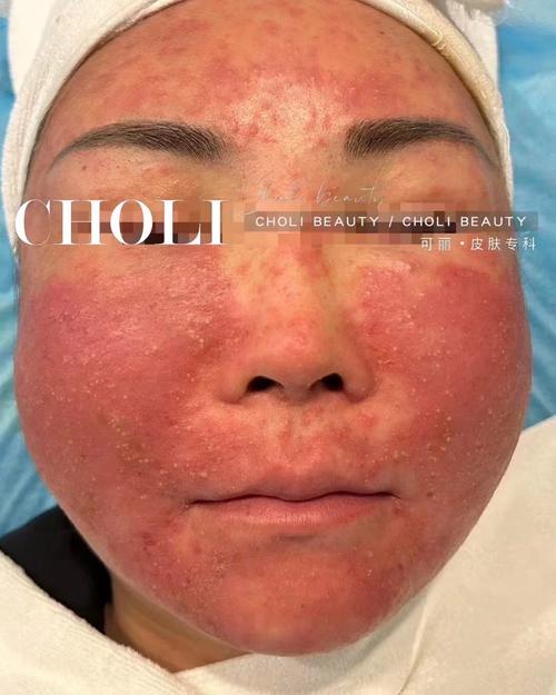  激素治疗