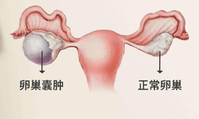 卵巢囊肿