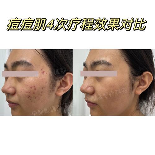 疗程效果