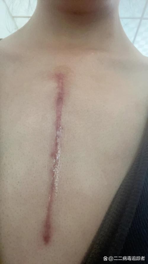  术后恢复