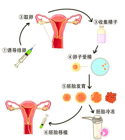 试管婴儿关键步骤