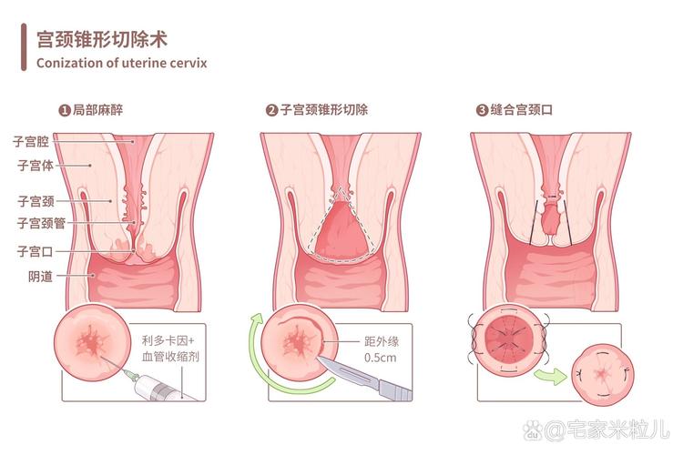 宫颈锥切术