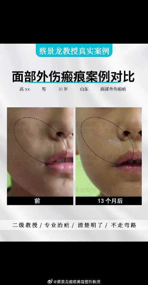  疤痕治疗