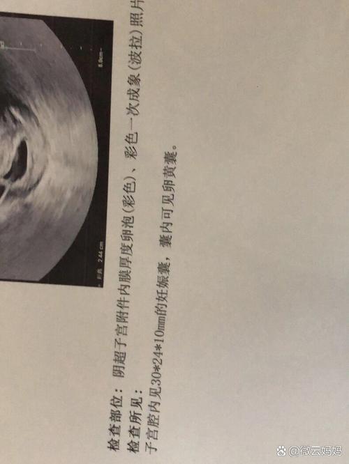 胎心停止发育
