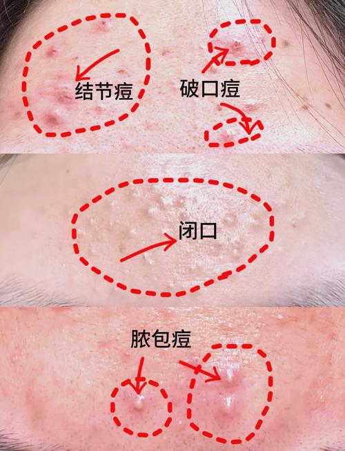 长痘
