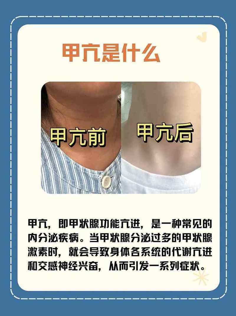 男性甲亢